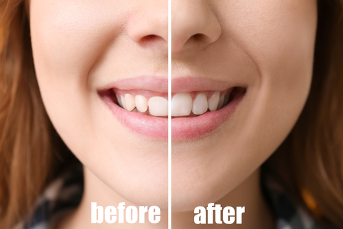 השתלת שיניים